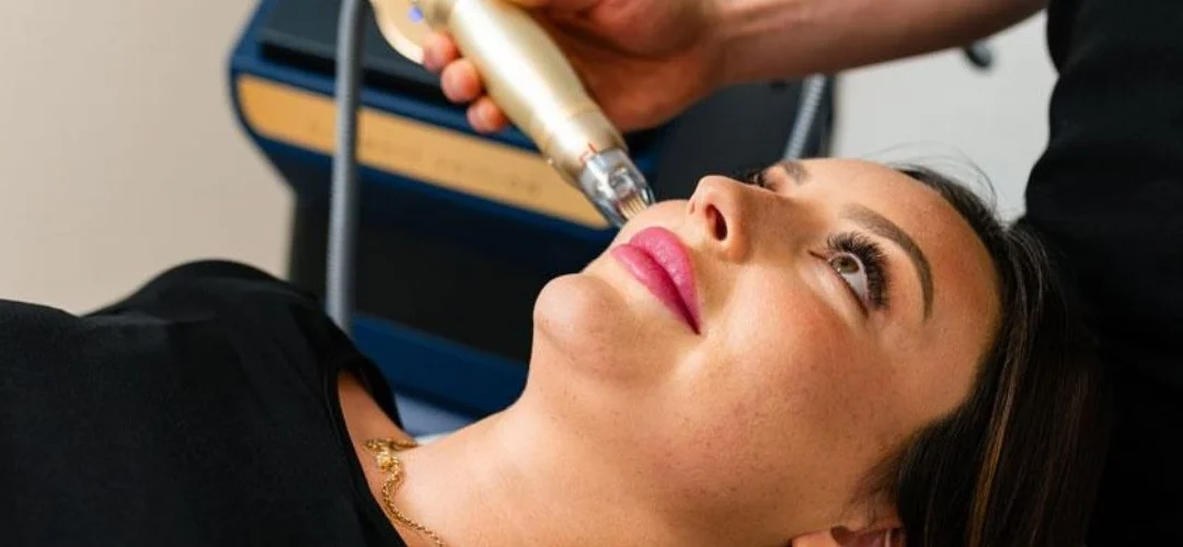 Allt du måste veta om RF-microneedling (Sylfirm X)